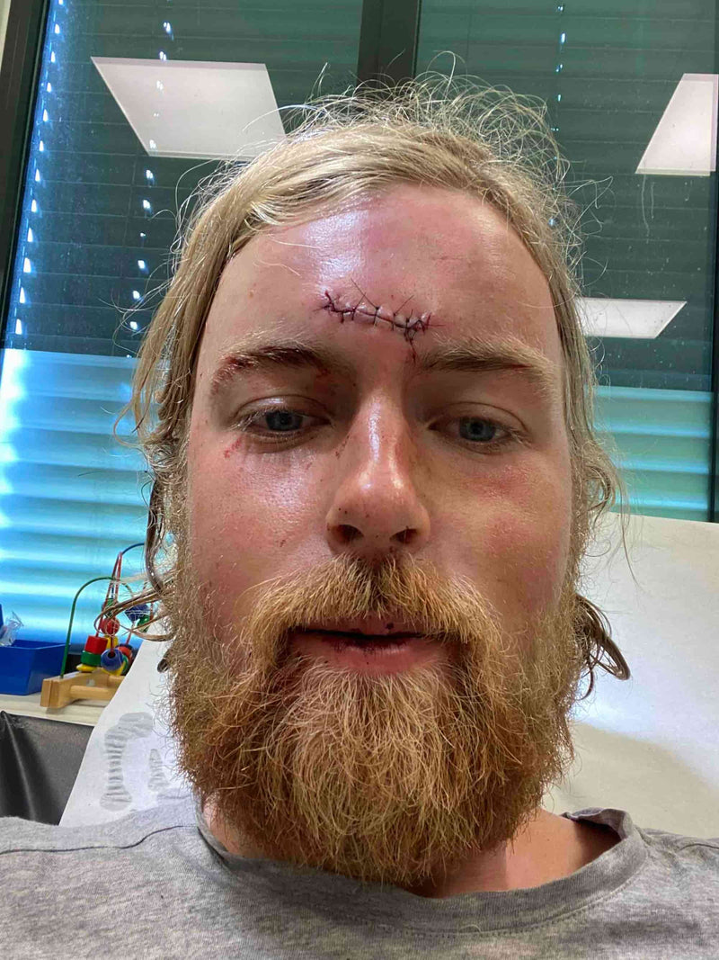 Forehead stitches from a surfing injury — the inspiration behind Sjo Protection
